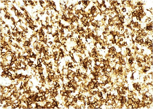 Figure showing immunohistochemistry slide positive for CD-20 (power off magnification at ×200).