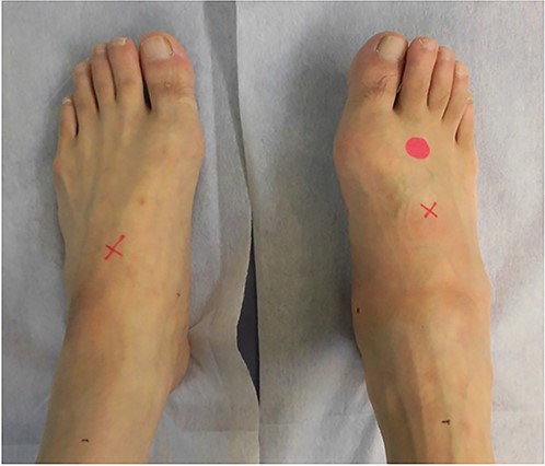 Physical examination shows swelling and deformity of the right foot.