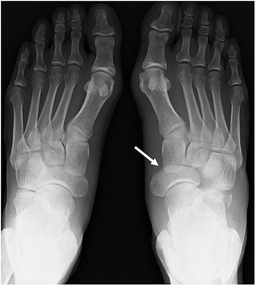 A plain radiograph shows lateral dislocation of the naviculocuneiform and calcaneocuboid joints of the right foot (arrow). The difference between the two sides is obvious.