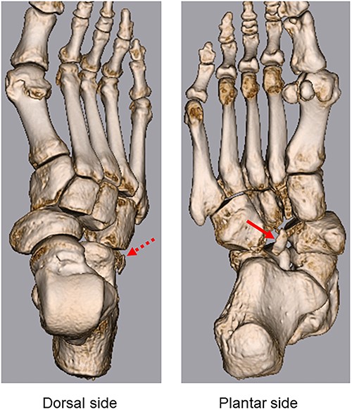 3D CT shows lateral dislocation of the naviculocuneiform and calcaneocuboid joints of the right foot, with fractures of the anterior edge of the calcaneus (broken arrow) and medial edge of the cuboid (arrow).