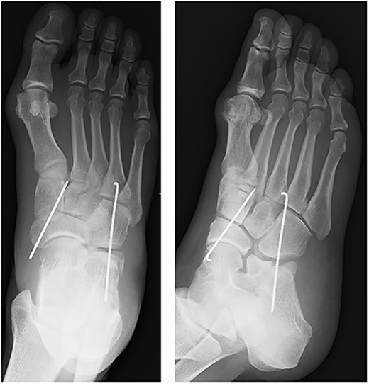 After fixation with K-wires. The dislocated site is reduced and stabilized.