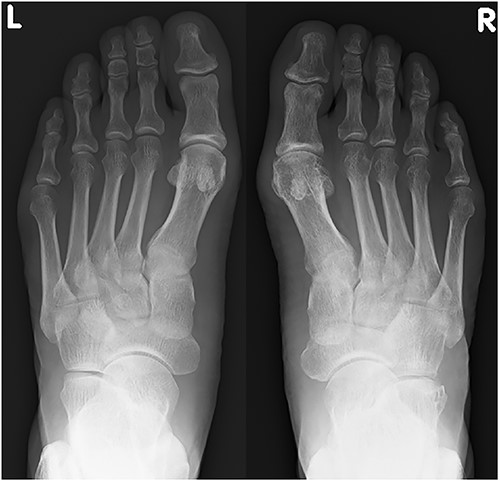 Plain radiograph at 1 year after the initial operation. There was no marked malalignment in the right foot.