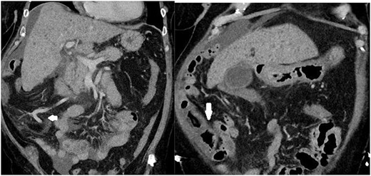Images depicting a single slice of the CT Abdomen/Pelvis with contrast completed on admission. Arrows pointing to subtly dilated mesenteric vessels, as well as thickened bowel affected by PHC, is depicted in Fig. 2.