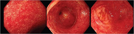 Endoscopic images depicting macroscopic findings of PHC including vascular ectasias and nonspecific inflammatory mucosal changes leading to friable mucosa which bled on contact.