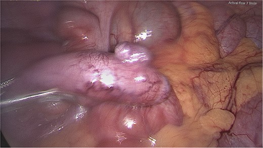 Appendix diverticulum, intraoperative photo.