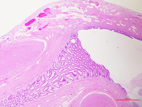 Hematoxylin and eosin staining, ×20, showing the tip of the appendix. Outpouching of the appendiceal mucosa through the muscular wall.
