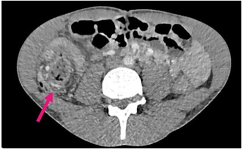 Contrast CT axial sections showing the enhanced thickened appendix (white) intussuscepts with fat stranding, into the ascending colon. Distal faecal loading also observed.
