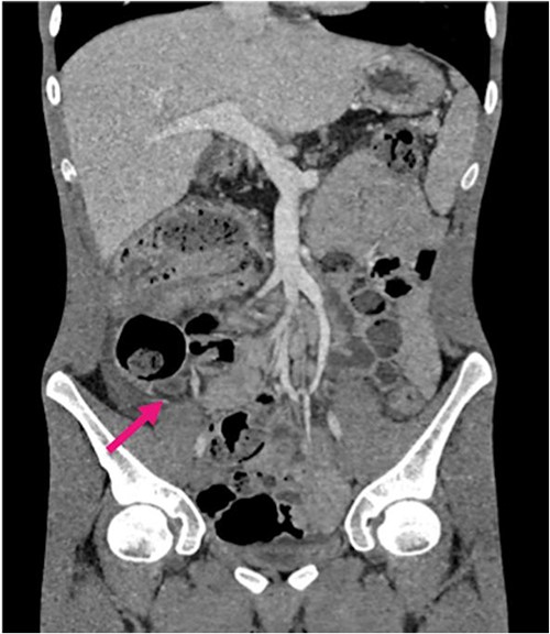 Contrast CT coronal sections depicting the classical ‘bullseye sign’ of intussusception of the caecum into the ascending colon.
