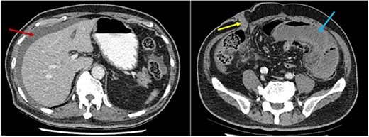 CT scan axial slices demonstrating perihepatic free fluid (red arrow) and dilated loops of small bowel in the left iliac fossa (blue arrow). The ileal conduit (yellow arrow) in the right iliac fossa appears healthy.