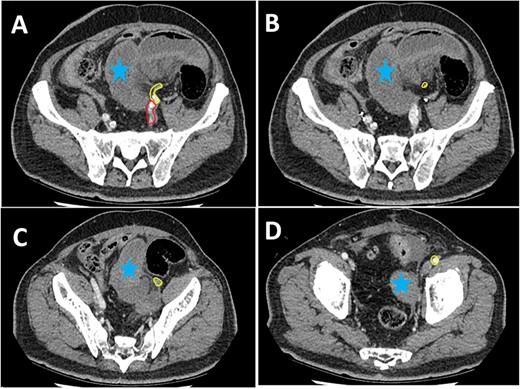Series of axial images of initial CT progressing from most superior (image A) to inferior (image D). The EIA has been highlighted in yellow from immediately inferior to the bifurcation of the common iliac artery. The internal iliac artery can be seen in red in image A. Images B and C demonstrate a collapsed EIA between dilated loops of small bowel suggesting involvement in the internal hernia. Image D demonstrates opacification of the EIA indicating flow distal to the internal hernia. Dilated loops of bowel have been marked with a blue star.