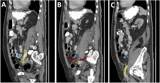 Post-operative CT scan. Series of sagittal images progressing from most medial (image A) to most lateral (image C). The patent EIA has been highlighted in yellow. Surgical clips are noted in image B (red arrow). Normal small bowel is noted in all images (blue stars).