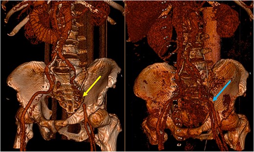 Three-dimensional reconstruction of the pre-operative (left) and post-operative (right) CT scan. The pre-operative CT demonstrates a segment of EIA that cannot be reconstructed due to the slow flow through the segment involved in the SBO (yellow arrow). The post-operative image demonstrates a patent EIA following vascular repair (blue arrow).