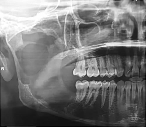 OPG showed radiolucent lesion including most of the right ramus area.