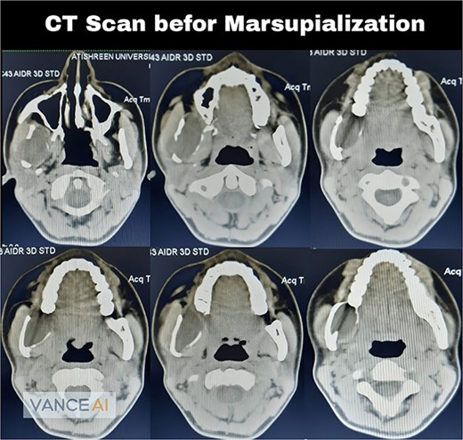 Computed tomography scan showed a cavity in the right mandibular ramus with expansion and absence of most buccal and lingual bone plates.