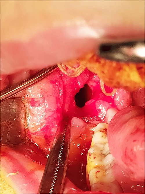 Marsupialization procedure: exposure of the cystic cavity, 1 cm size window was made into the cyst cavity.