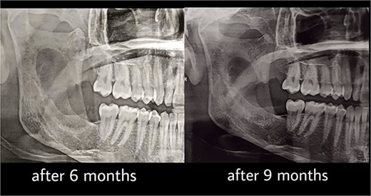 Follow-up after 6 and 9 months.