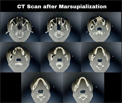 Computed tomography after 12 months showed a bone regeneration in the lesion’s area and the cystic lesion has become completely surrounded by thick bony plates.