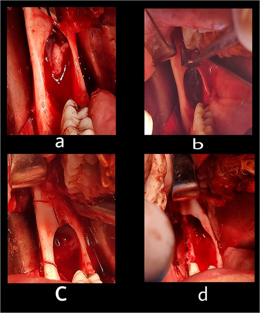 The second stage: (a) surgical exposure of the right anterior border of the ramus. (b) The cystic cavity after the enucleation of the lesion. (c) Removal of the buccal plate to allow access to the entire of the lesion. (d) The cystic cavity after removal of buccal plate and peripheral ostectomy.