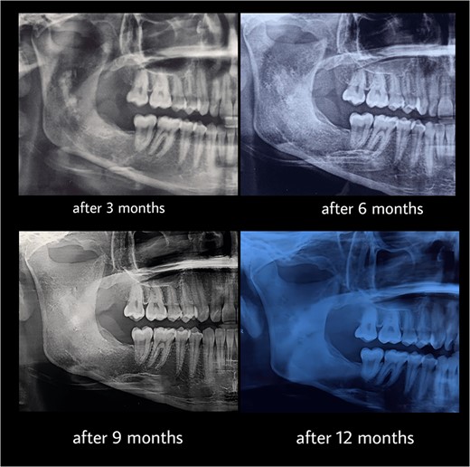 Follow-up after 3, 6, 9, 12 months of the second stage.