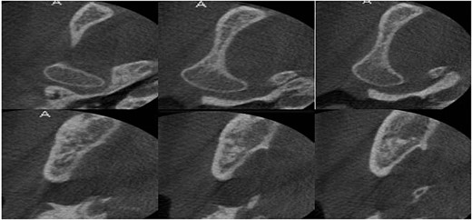 Cone beam computed tomography after 30 months showed full healing without any recurrence.