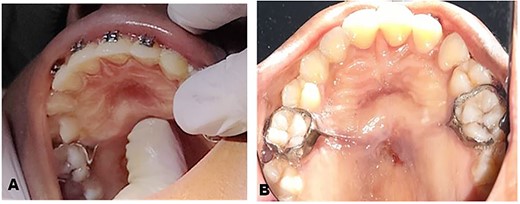Preoperative clinical photographs: (A) Preoperative clinical picture showing clinical examination of the palate. (B) Preoperative clinical picture showing buried Nance palatal arch appliance after administration of LA.
