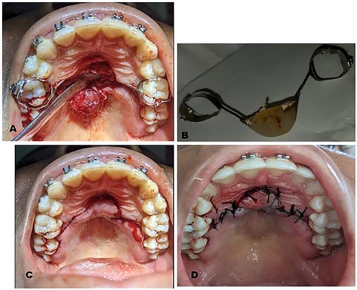Intraoperative clinical photographs: (A) Trans-surgical view: partial thickness palatal mucosa flap raised using a periosteal elevator to expose buried Nance appliance. (B) Nance appliance delivered out of the palatal mucosa. (C) Trans-surgical view: raised flap repositioned and showing the outline of incision made. (D) Repositioned flap sutured using black silk sutures.