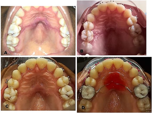Postoperative clinical photographs: (A) One week postoperative photograph after suture removal. (B) Two weeks postoperative photograph. (C) Four weeks postoperative photograph. (D) Six weeks postoperative photograph after fitting of new Nance appliance.