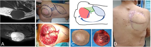 A 76-year-old male with a fibrosarcoma in the right posterior shoulder. MRI shows a subcutaneous tumor with a low-signal intensity on the T1-weighted image (A-top) and a high-signal intensity on a T2-weighted fat-suppressed image (A-bottom). After resection of the tumor with the surrounding tissue (B), the schematic reconstruction design is shown (C-top). The resected tumor was covered by normal skin and muscle tissue (C-bottom). The light green area is the scapular flap and the light blue area is the latissimus dorsi. Arrows show the direction of flap translocation. Asterisks (*) are sutured points. Postoperative view 2 years after reconstruction (D).