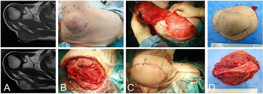 An 86-year-old male with a leiomyosarcoma in the right posterior shoulder. The subcutaneous tumor with a low-signal intensity on the T1-weighted image (A-top) and a heterogenous low-high signal intensity on the T2-weighted image (A-bottom). The surgical margin is designed (B-top) and resected with the underlying scapular spine (B-bottom). The latissimus dorsi is elevated (C-top). The primary suture is completed, but tight. Note that the skin at the possible scapular flap is loose (C-bottom). The resected sample is covered with normal tissue, including the scapular spine (D).