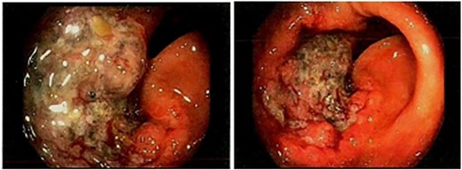 Pre-operative endoscopic photos of transverse colon mass.