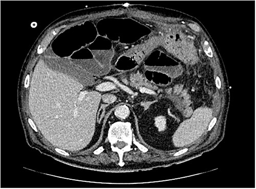 Transverse section of CT abdomen/pelvis performed on post-operative day 8, illustrating peripancreatic fluid and post-operative ileus.