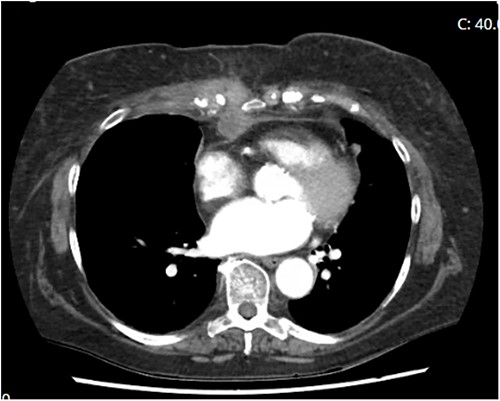 Computed tomography demonstrating penetrance of infection deep to sternum.