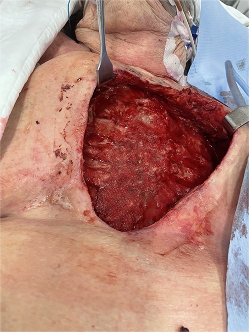 Sternectomy and costochondrectomy required for pathogenic clearance.