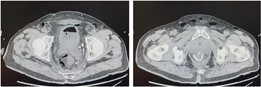 Contrast CT scan: ‘Abundant fluid-air presence in the presacral space and in the mesorectum at the level of the colo-rectal anastomosis, and a discontinuity on the posterior side of the colonic wall’.
