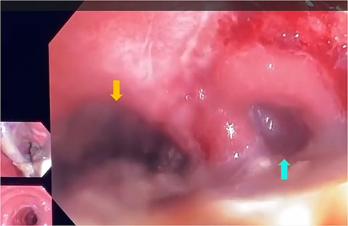 Low-flow endoscopic exploration which confirmed the presence of dehiscence of the colorectal anastomosis in the right postero-lateral colonic wall, 7 cm from the anal verge, giving access to a large cavity filled with fibrin and necrotic tissue (yellow arrow), colic lumen (blue arrow).