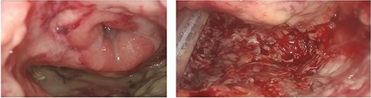 The visualisation of the right posterolateral dehiscence, the adjacent cavity (measuring 4 cm × 3 cm) with drainage by TAMIS approach.