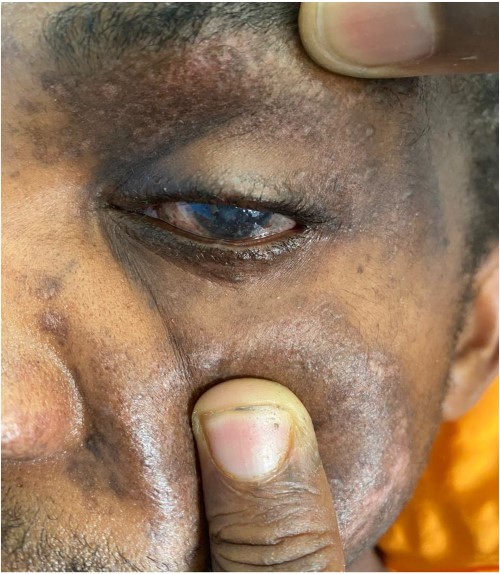 Conjunctival injury of the left eye of the patient, with multiple left periocular scars sustained from the blast injury.