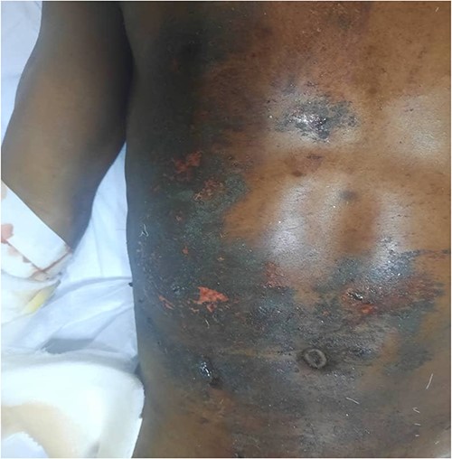 Presentation of multiple severe burn wounds on the anterior aspect of the abdomen and pelvis sustained following the blast injury.