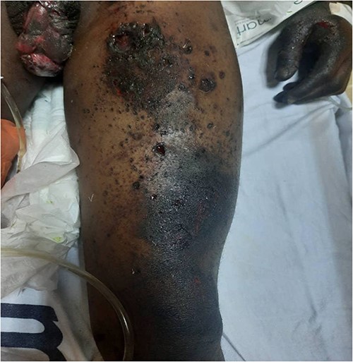 Rupture of the left hemiscrotum with exposed testis in the patient, with multiple deep burn wounds on the left thigh.
