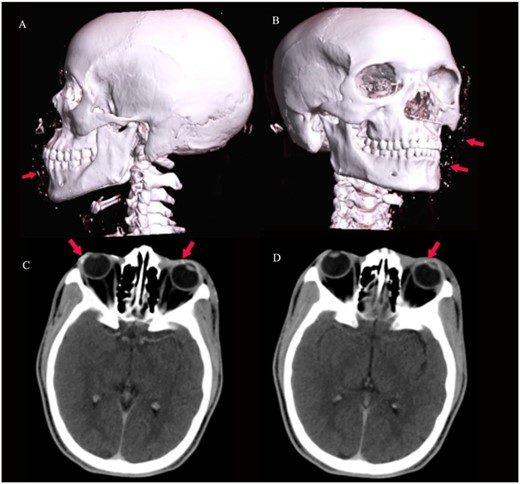 3D virtual reconstruction images (A and B) show multiple radio-opaque foreign bodies in the subcutaneous tissue of the face, as shown by arrows. Axial CT of the brain (C and D) at the level of the orbits shows conjunctival foreign bodies (shrapnel), as shown by arrows.