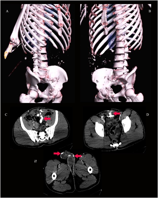 3D virtual reconstruction images (A and B) and axial CT pelvis (C, D and E) show innumerable radio-opaque foreign bodies (shrapnel) in the peritoneal cavity, anterior rectus abdominis muscle and the subcutaneous tissue of the penis, scrotum and left thigh, as shown by arrows.