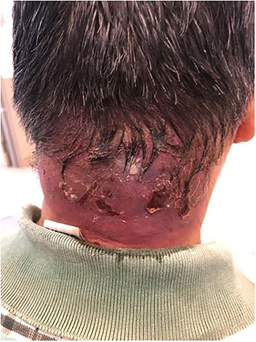 Pre-operative neck carbuncle.