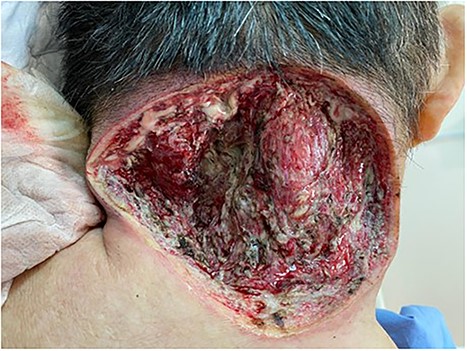 Wound post-saucerization.