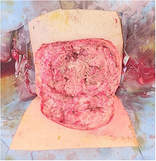 Relook debridement.