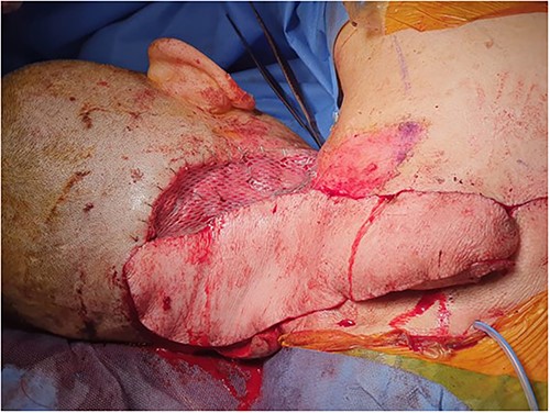 Lower trapezius dorsal scapular artery flap.