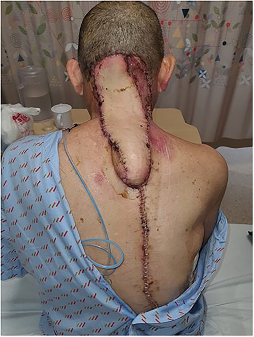 Post-operation day 2.