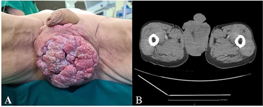 (A) Ulcerating painless tumor in the scrotum, (B) heterogenous tumor mass in the projection of scrotum (CT).