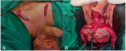 (A) Funiculus spermaticus cut below the clamping site, (B) circularly cut in the skin of the scrotum within the boundaries of the healthy tissue.