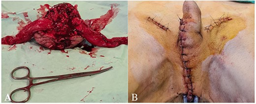 (A) The scrotum with testicles and spermatic cords removed in one specimen, (B) the perineal area drained with two drainage tubes.