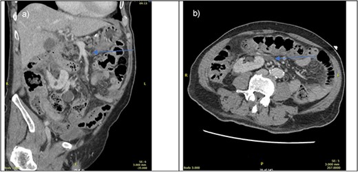 CT portal venous phase (left—sagittal slice, right axial slice) of imaging done upon presentation. Blue arrow pointing towards suspected thrombus causing bowel ischaemia.